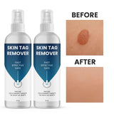 Skin Tag Remover 100 ml Pack of 2 Beauty & Personal Care